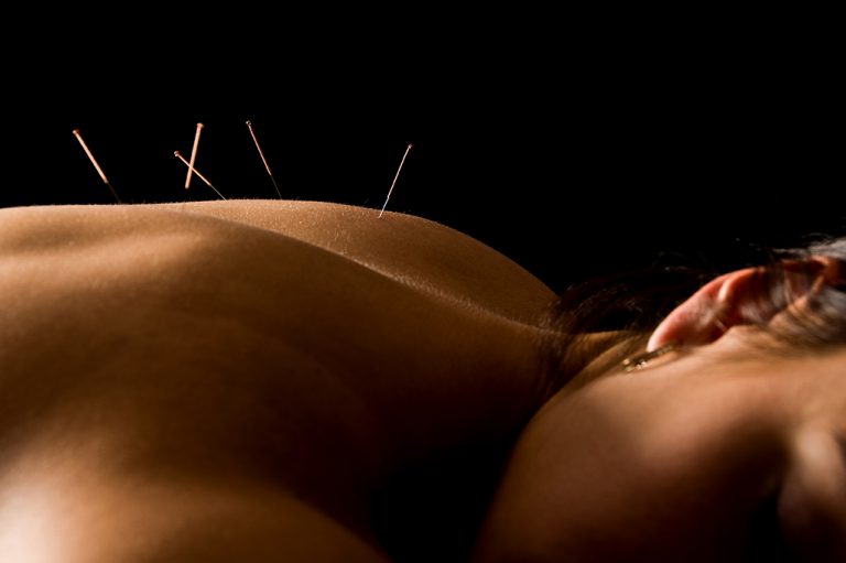 A patient receives Acupuncture.